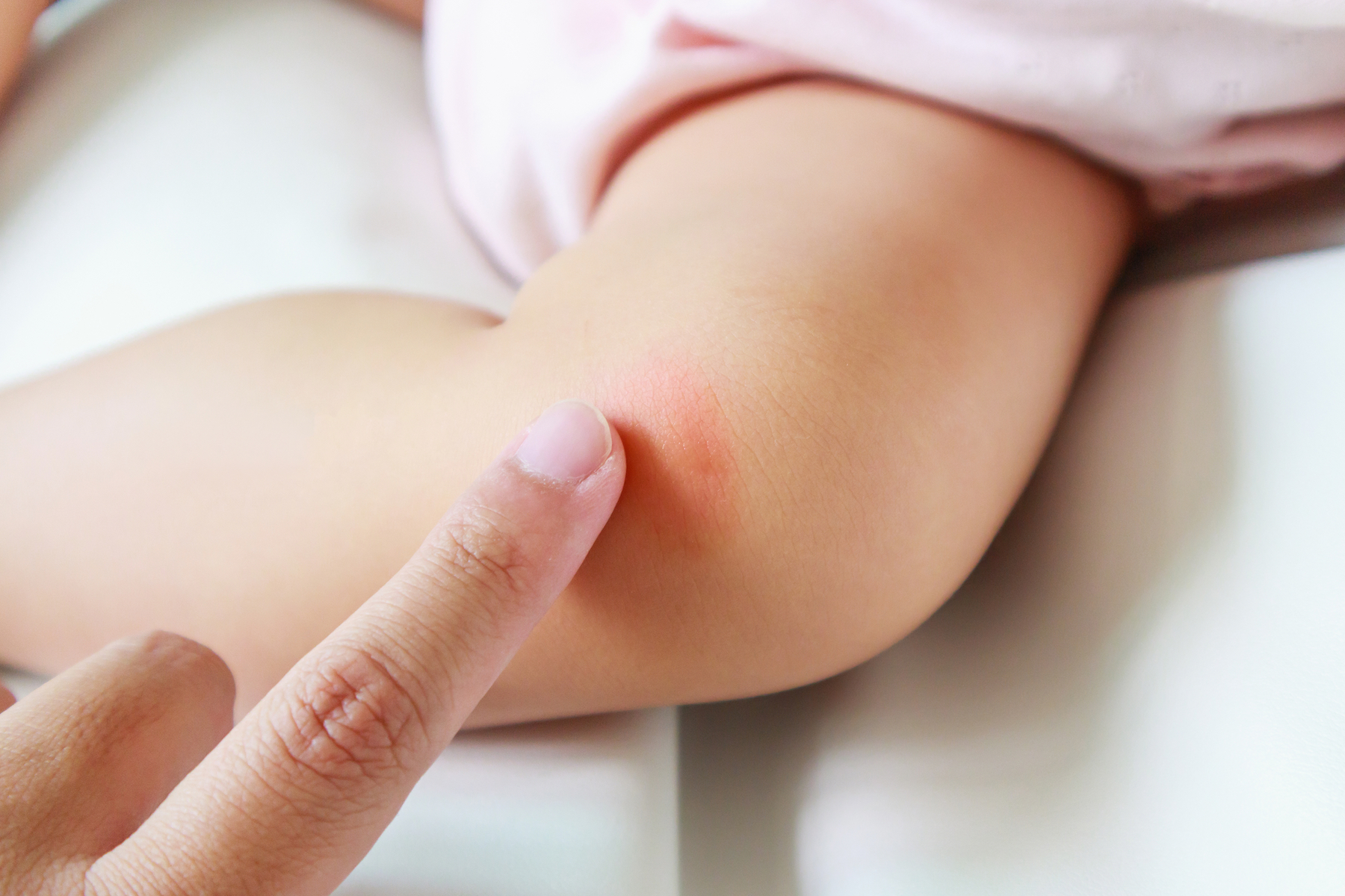 Ruam pada Bayi Bikin Gelisah? Yuk Atasi dengan Cara Ini!